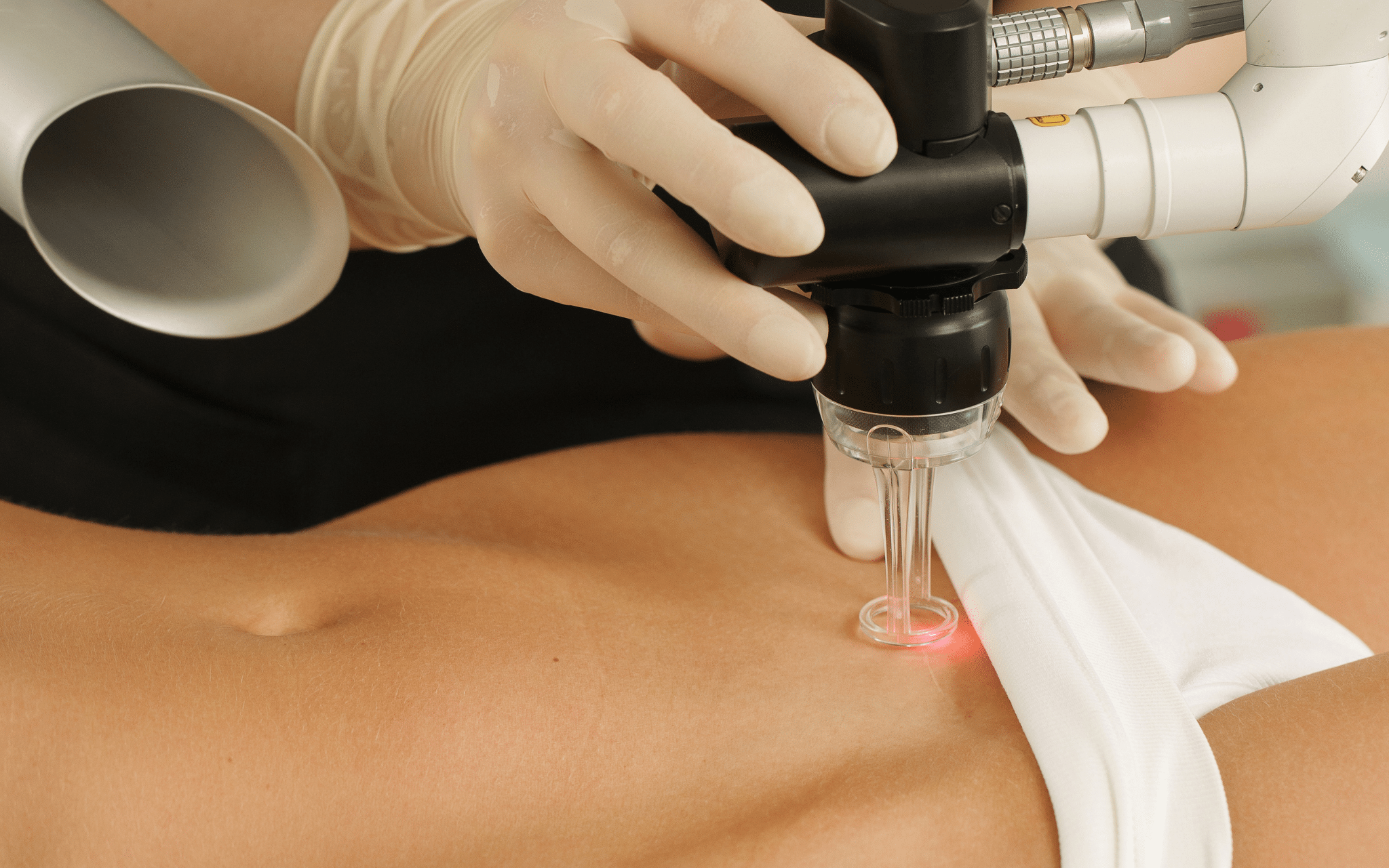 Лазерная шлифовка шрамов и удаление рубцов Лазерная шлифовка шрамов и удаление рубцов