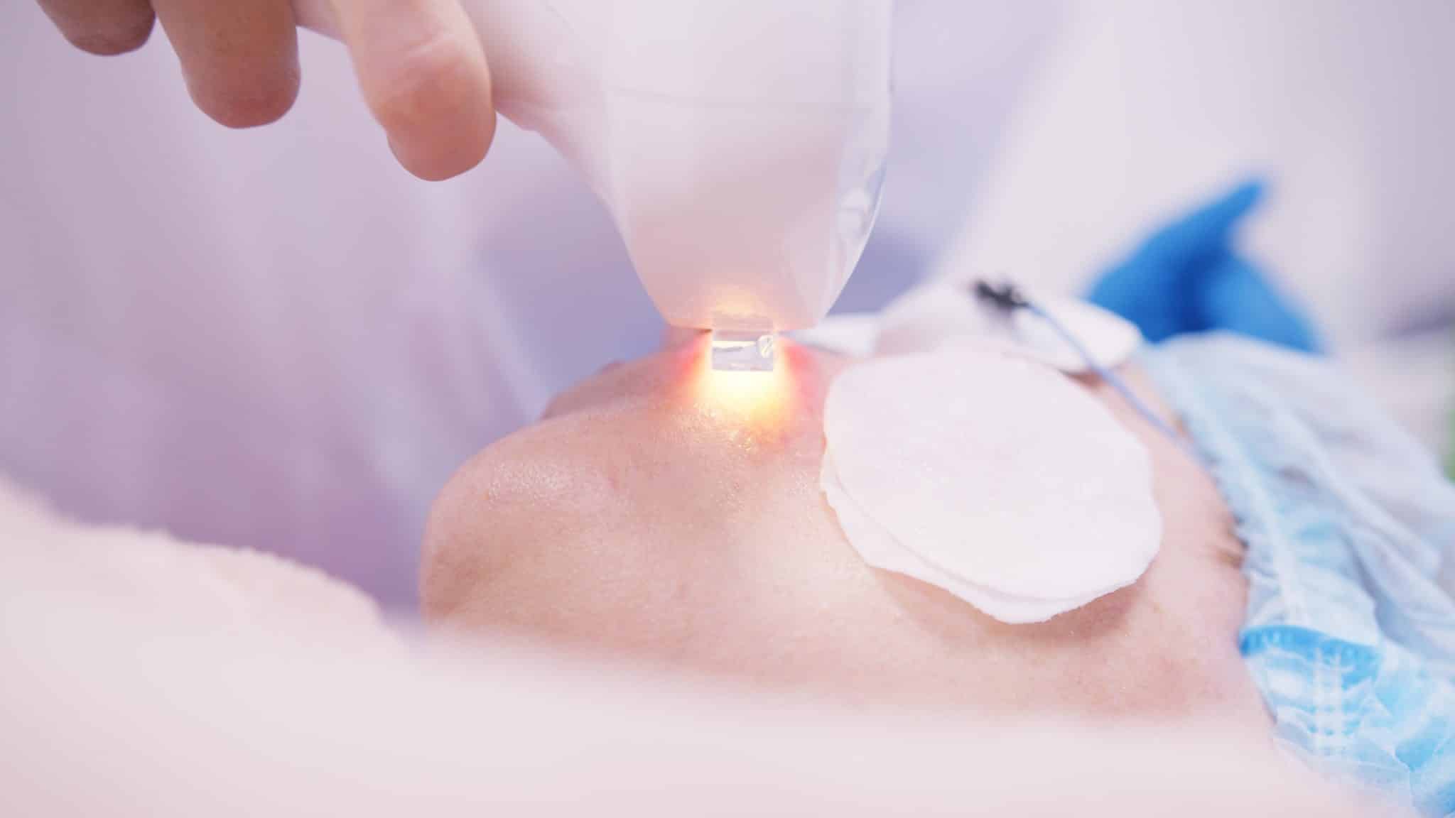 Дерматология Лазерное удаление шрамов в ADONIS