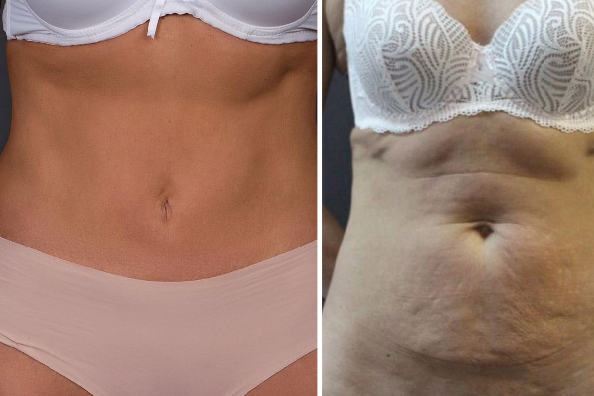 Абдоминопластика Абдоминопластика: фото до и после пластики живота в ADONIS