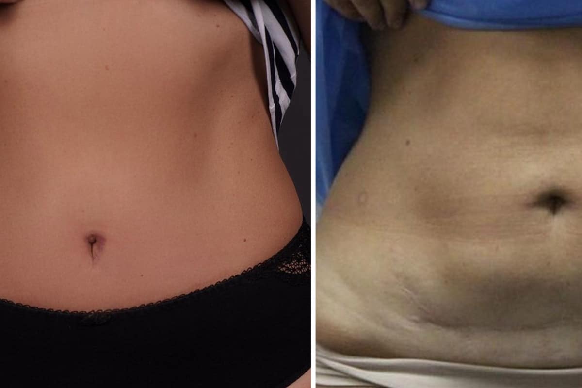 Абдоминопластика Абдоминопластика: фото до и после пластики живота в ADONIS.