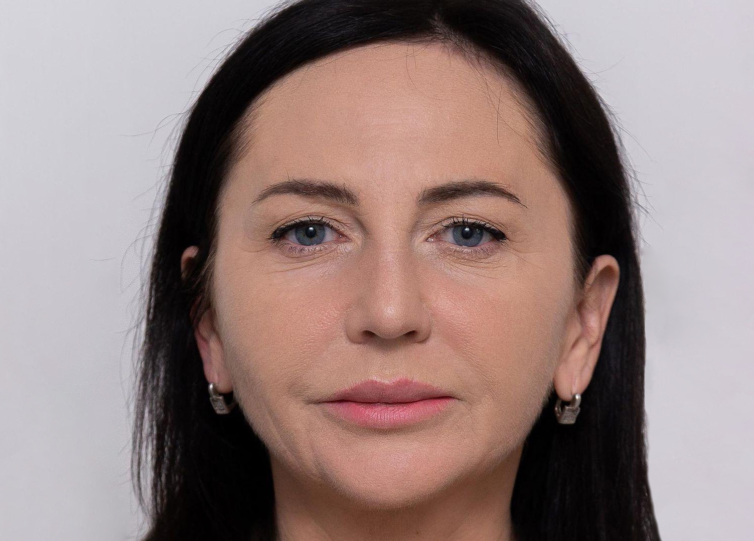 Ринопластика (пластика носа) в Киеве Ринопластика в МЦ ADONIS