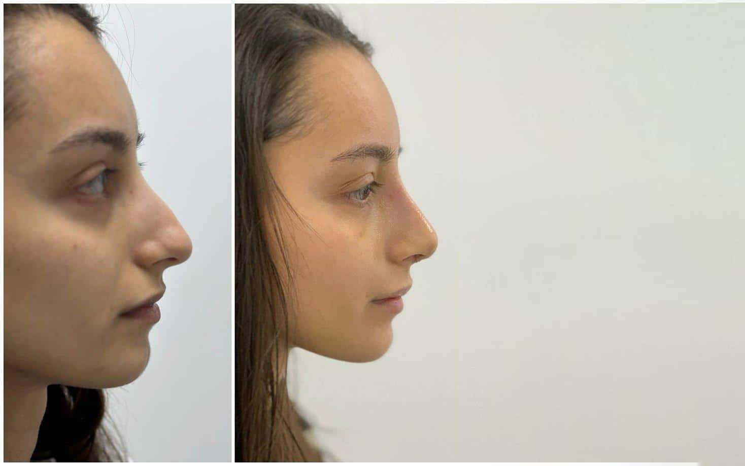 Пластическая хирургия в Киеве Ринопластика в МЦ ADONIS