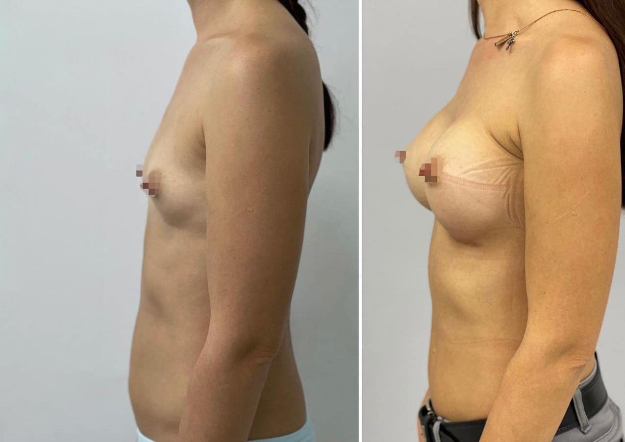 Маммопластика Операція з мамопластики в клініках ADONIS