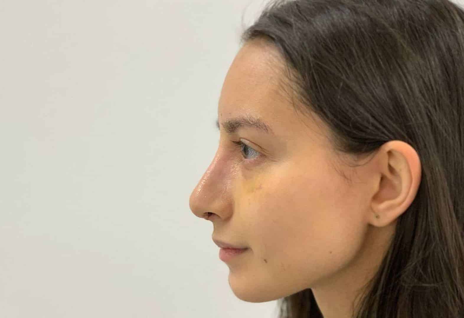 Ринопластика (пластика носа) в Киеве Ринопластика в МЦ ADONIS