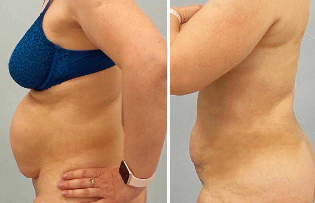 Абдоминопластика Абдоминопластика с липосакцией в ADONIS у Києві