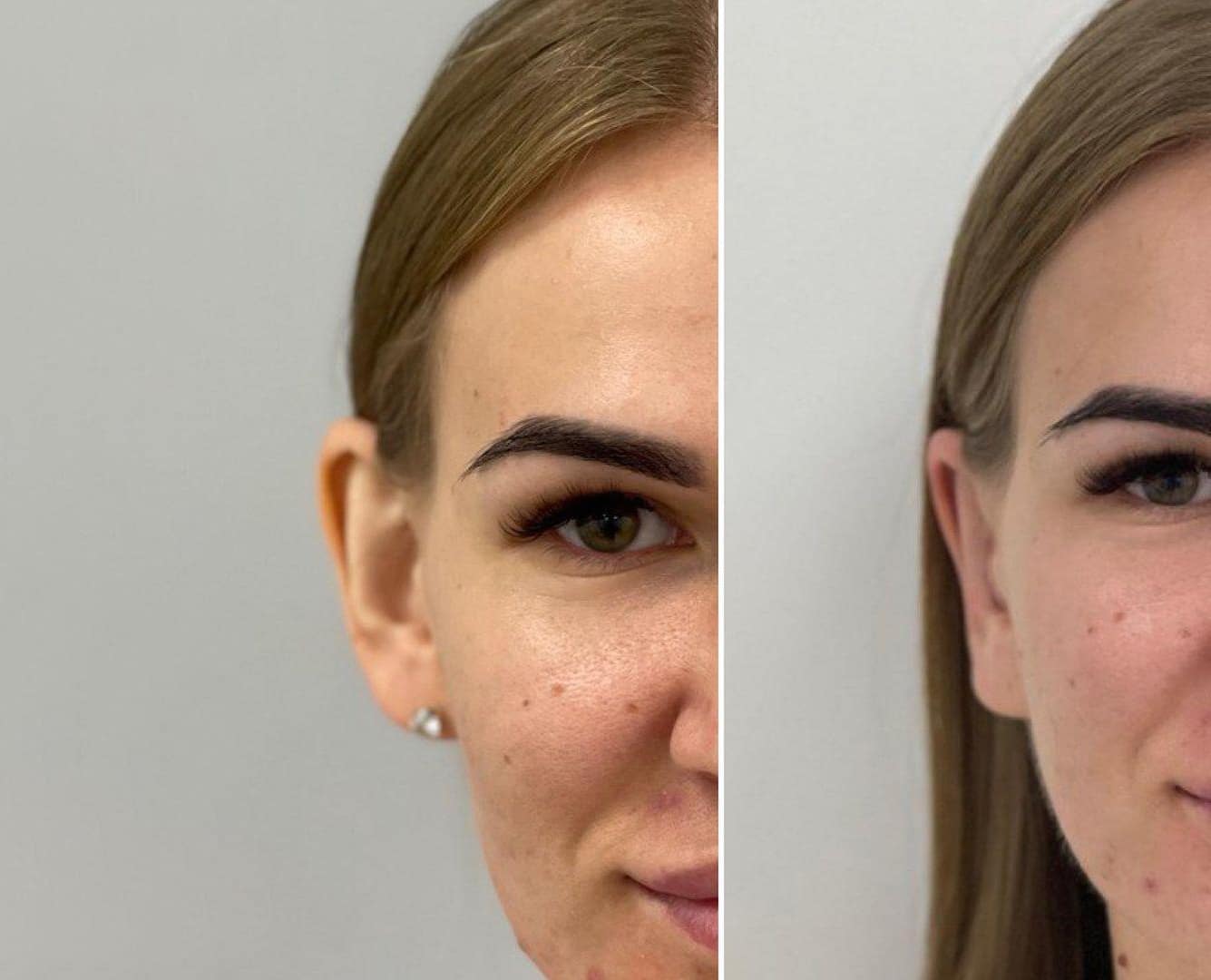 Отопластика (коррекция формы ушей) в Киеве Отопластика в МЦ ADONIS