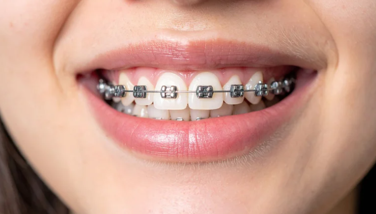 Ортодонтия Как проводится ортодонтическое лечение зубов в ADONIS?