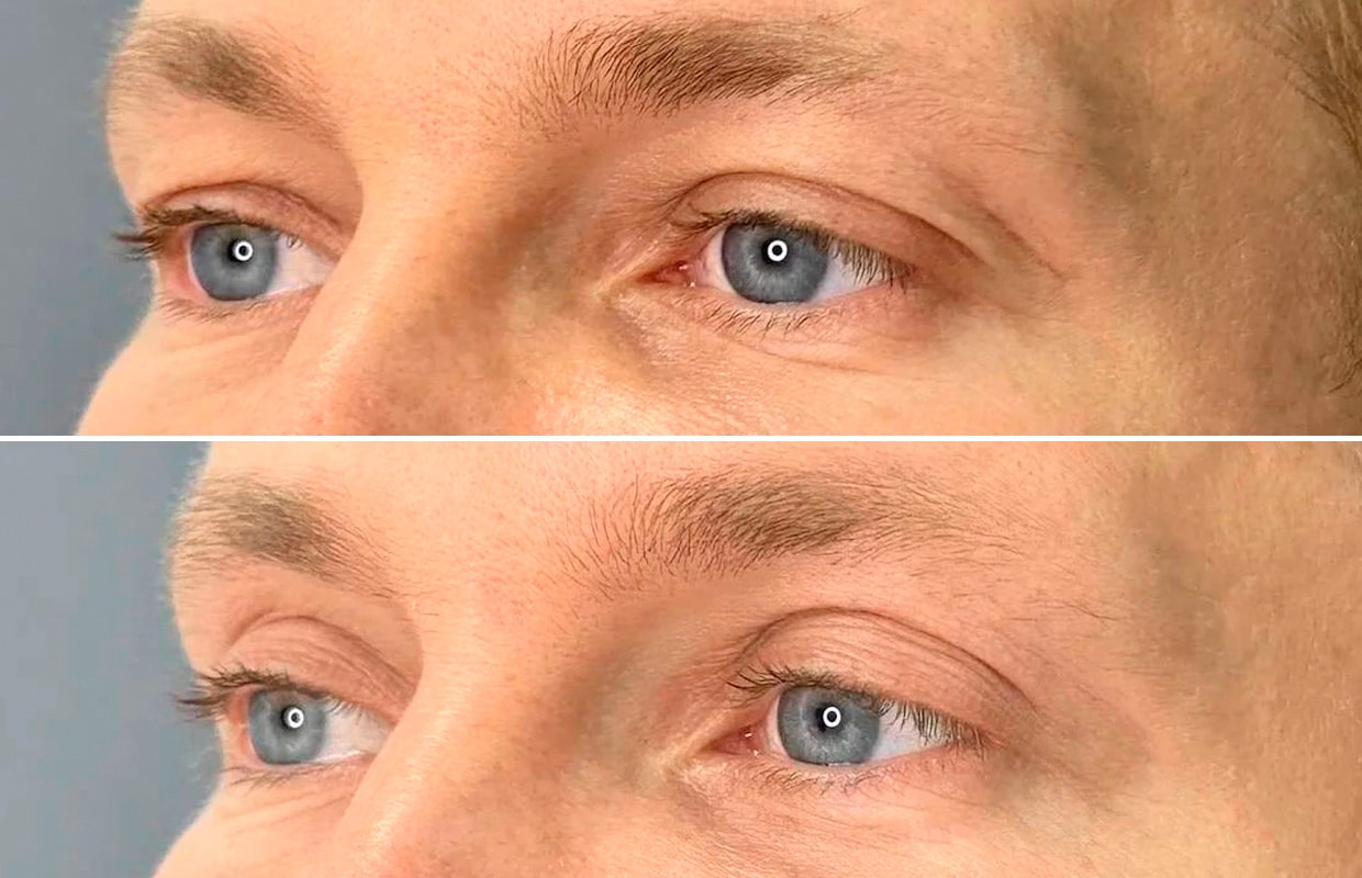 Лазерная блефаропластика Блефаропластика 1 ADONIS, Киев