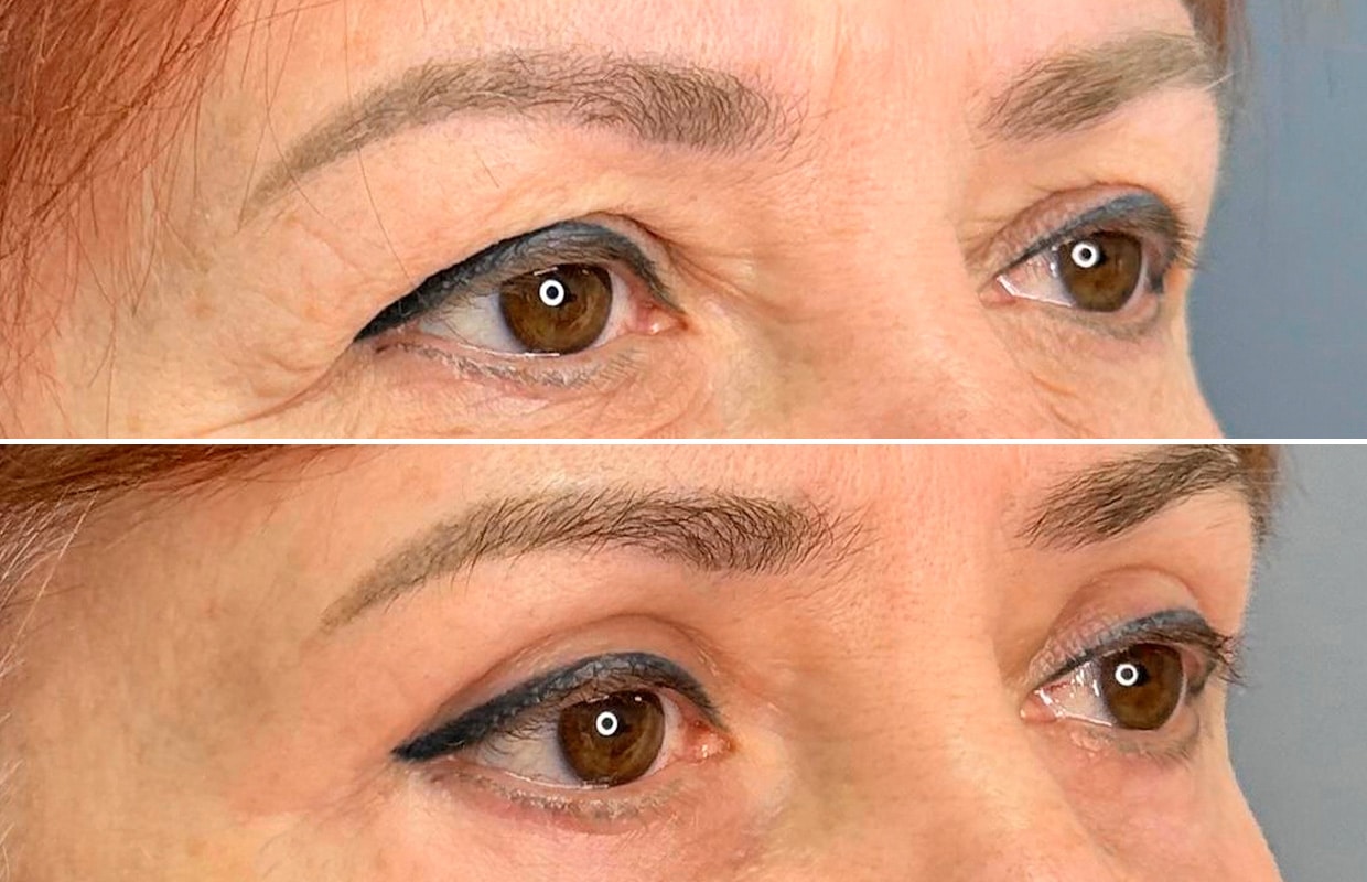 Лазерная блефаропластика Блефаропластика 2 в ADONIS, Киев