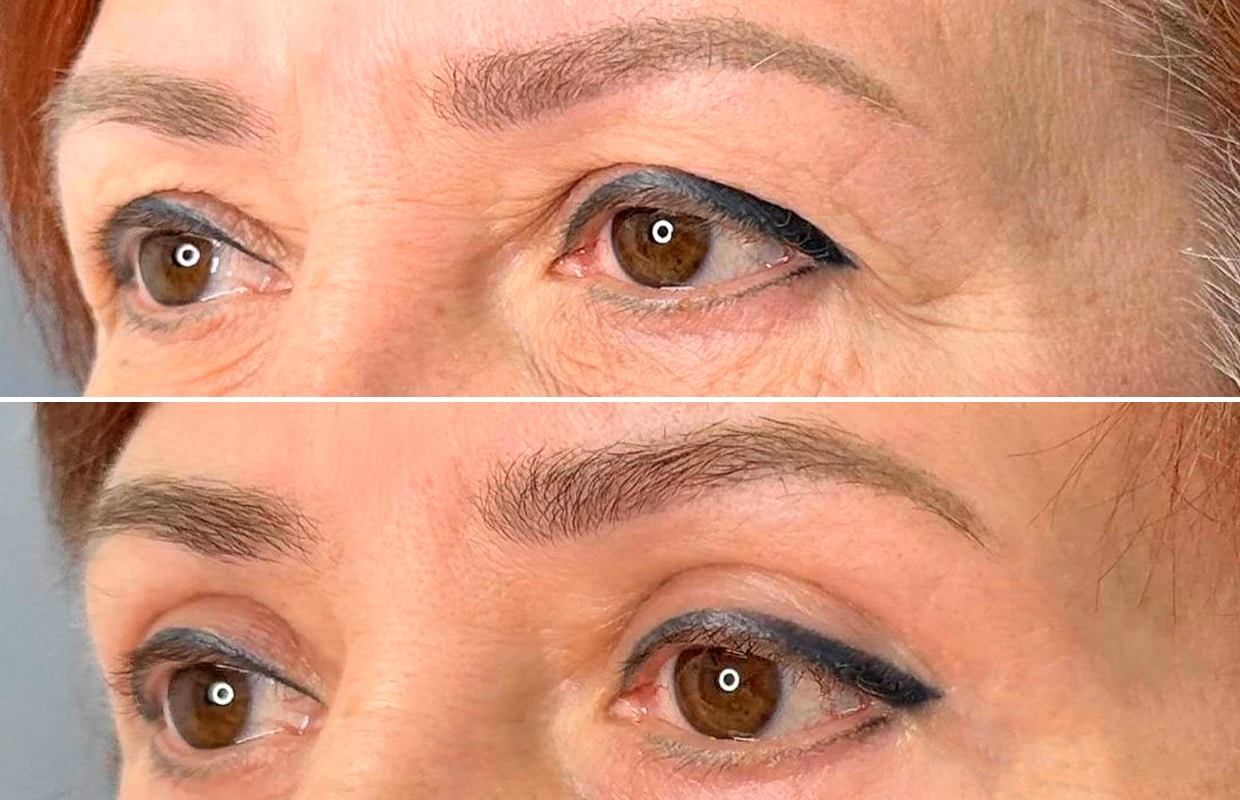 Лазерная блефаропластика Бблефаропластика 2 в ADONIS, Киев