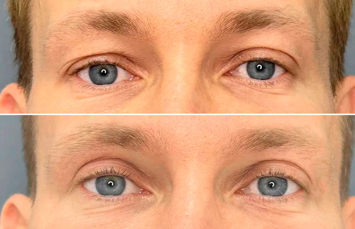 Лазерная блефаропластика Блефаропластики в ADONIS, Киев