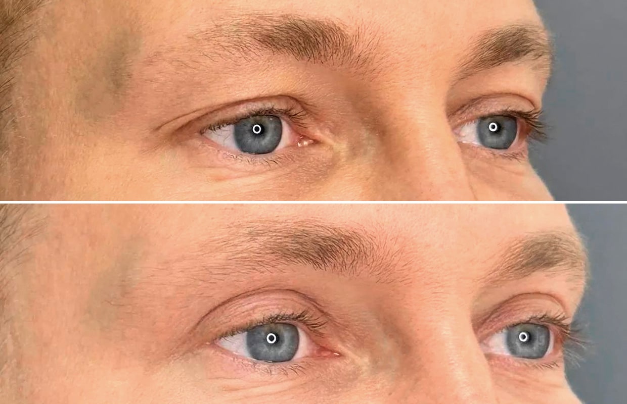 Лазерная блефаропластика Блефаропластики в ADONIS, Киев