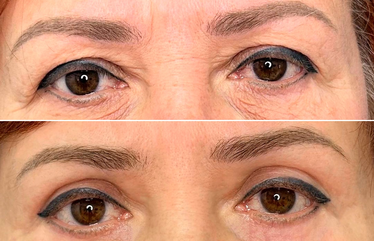 Лазерная блефаропластика Блефаропластика 2 в ADONIS, Киев