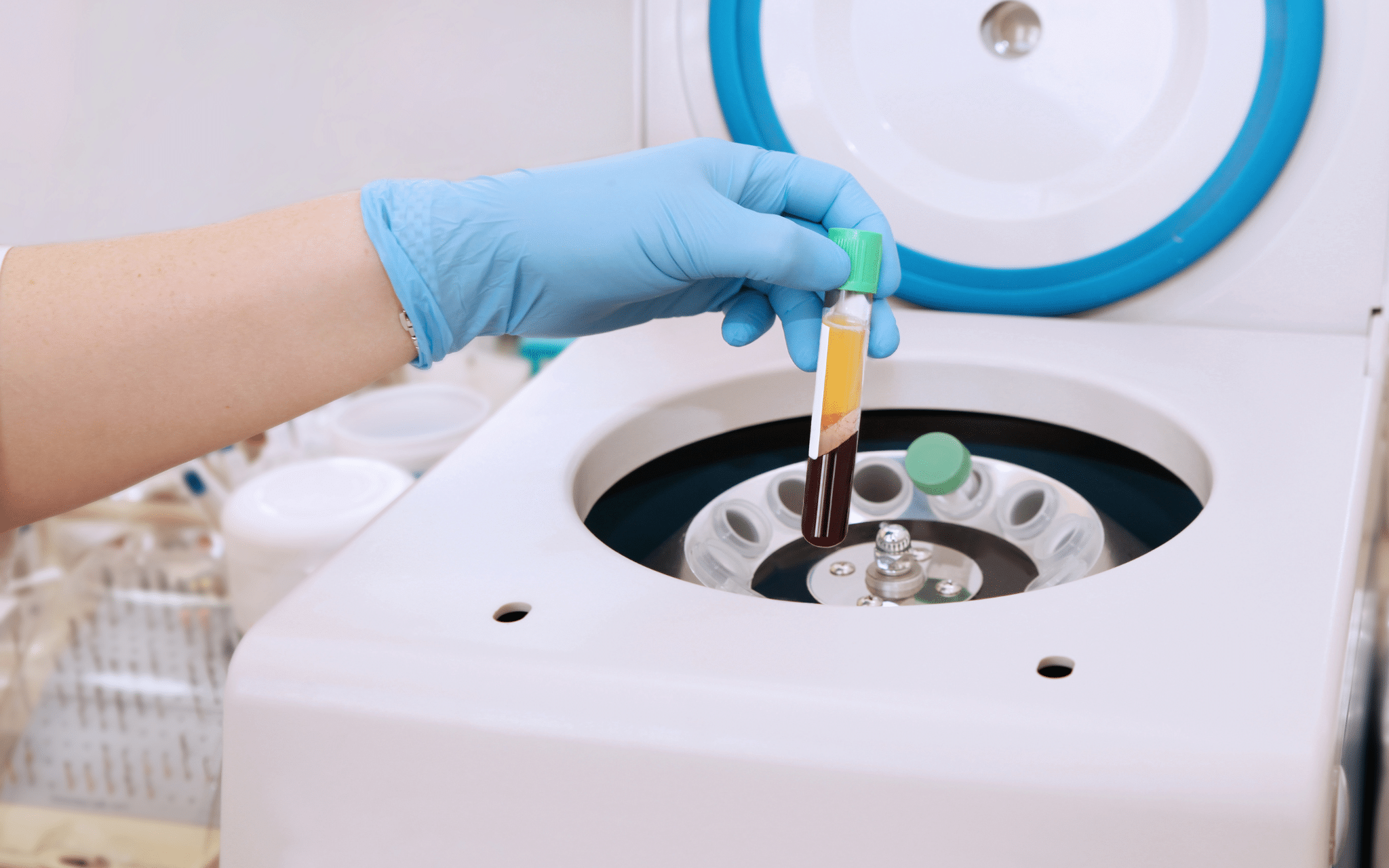 Що таке плазмоліфтінг і які ефекти він забезпечує? Що таке плазмоліфтінг і які ефекти він забезпечує?