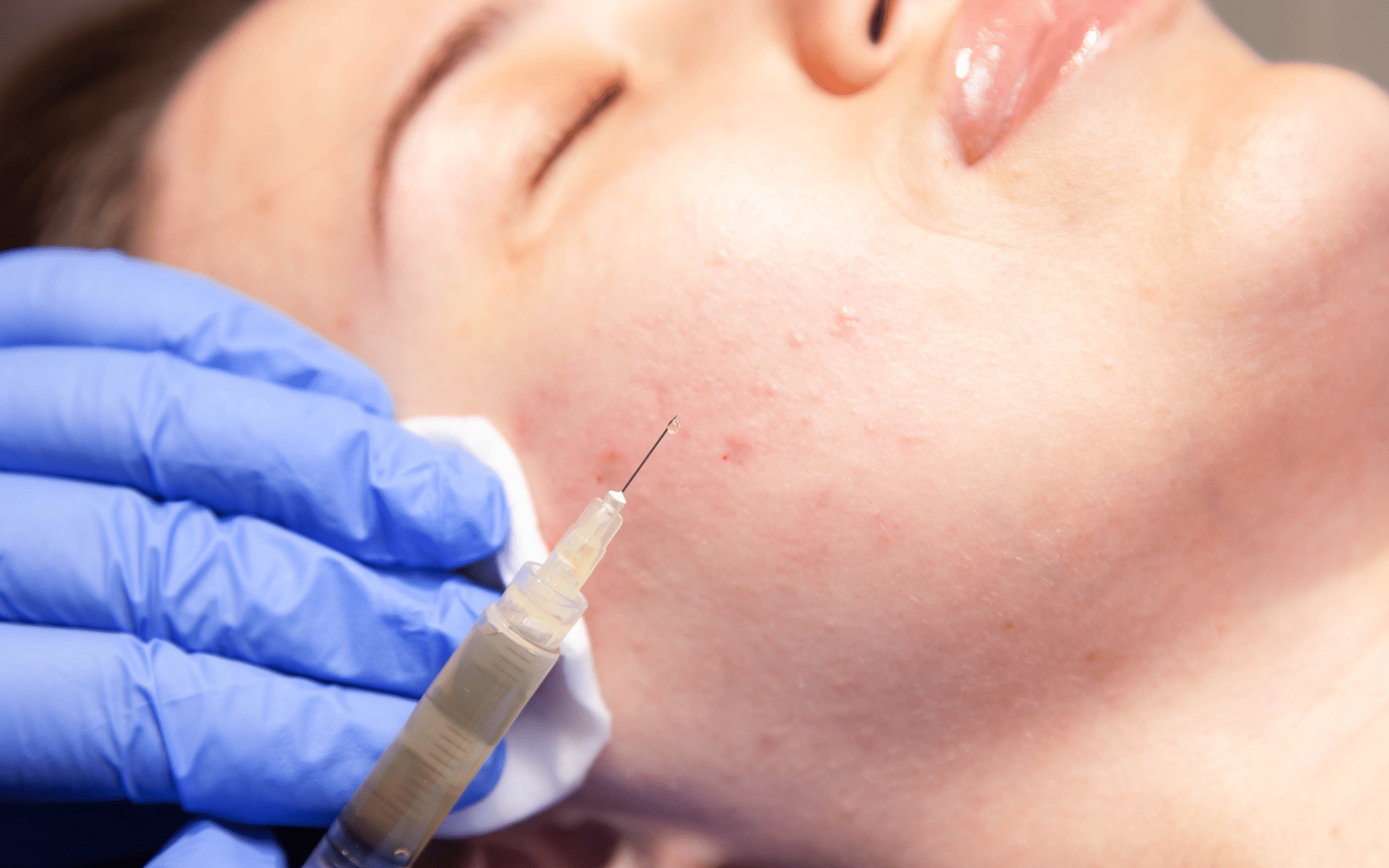 Що таке плазмоліфтінг і які ефекти він забезпечує? Що таке плазмоліфтінг і які ефекти він забезпечує?