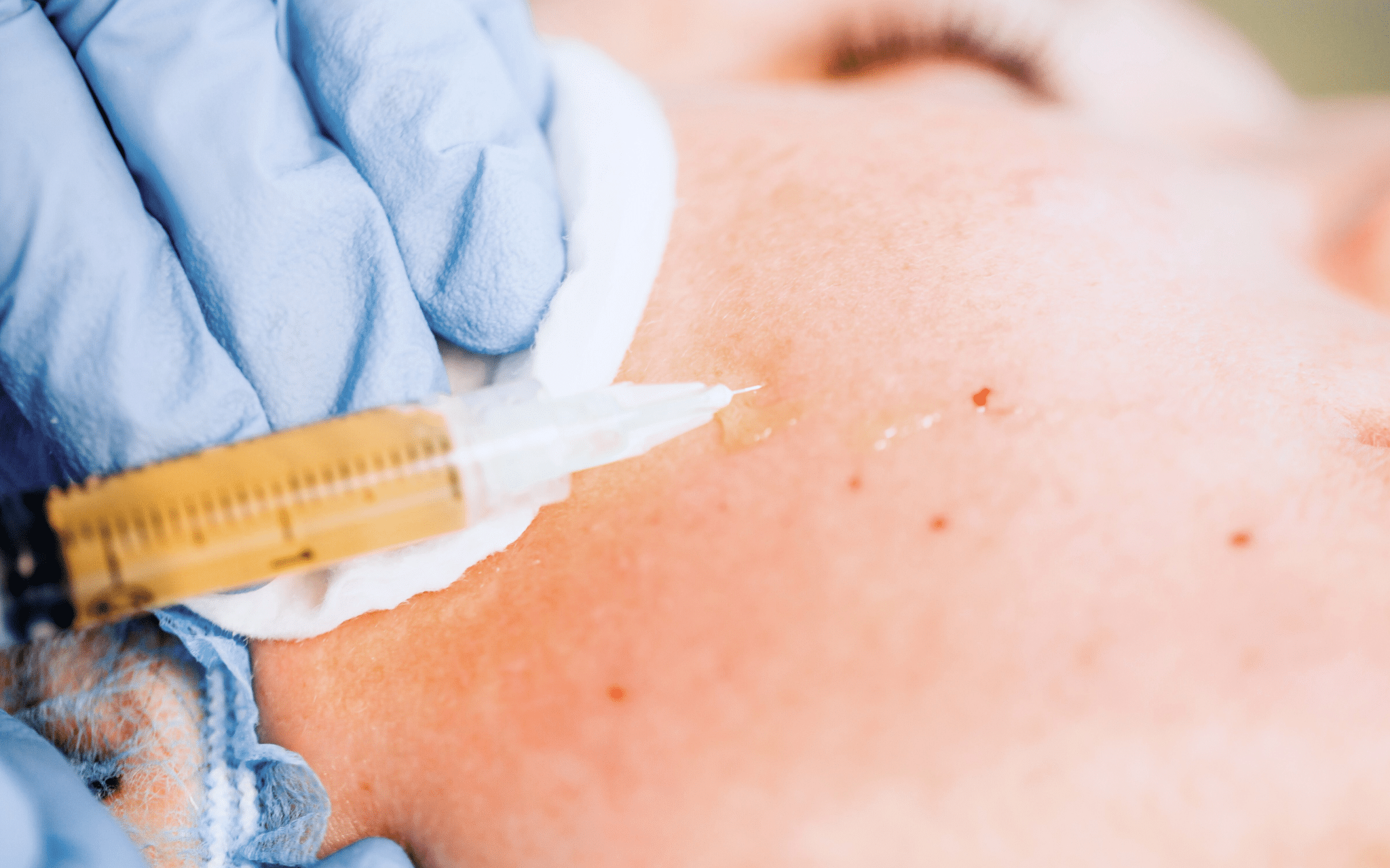 Що таке плазмоліфтінг і які ефекти він забезпечує? Що таке плазмоліфтінг і які ефекти він забезпечує?