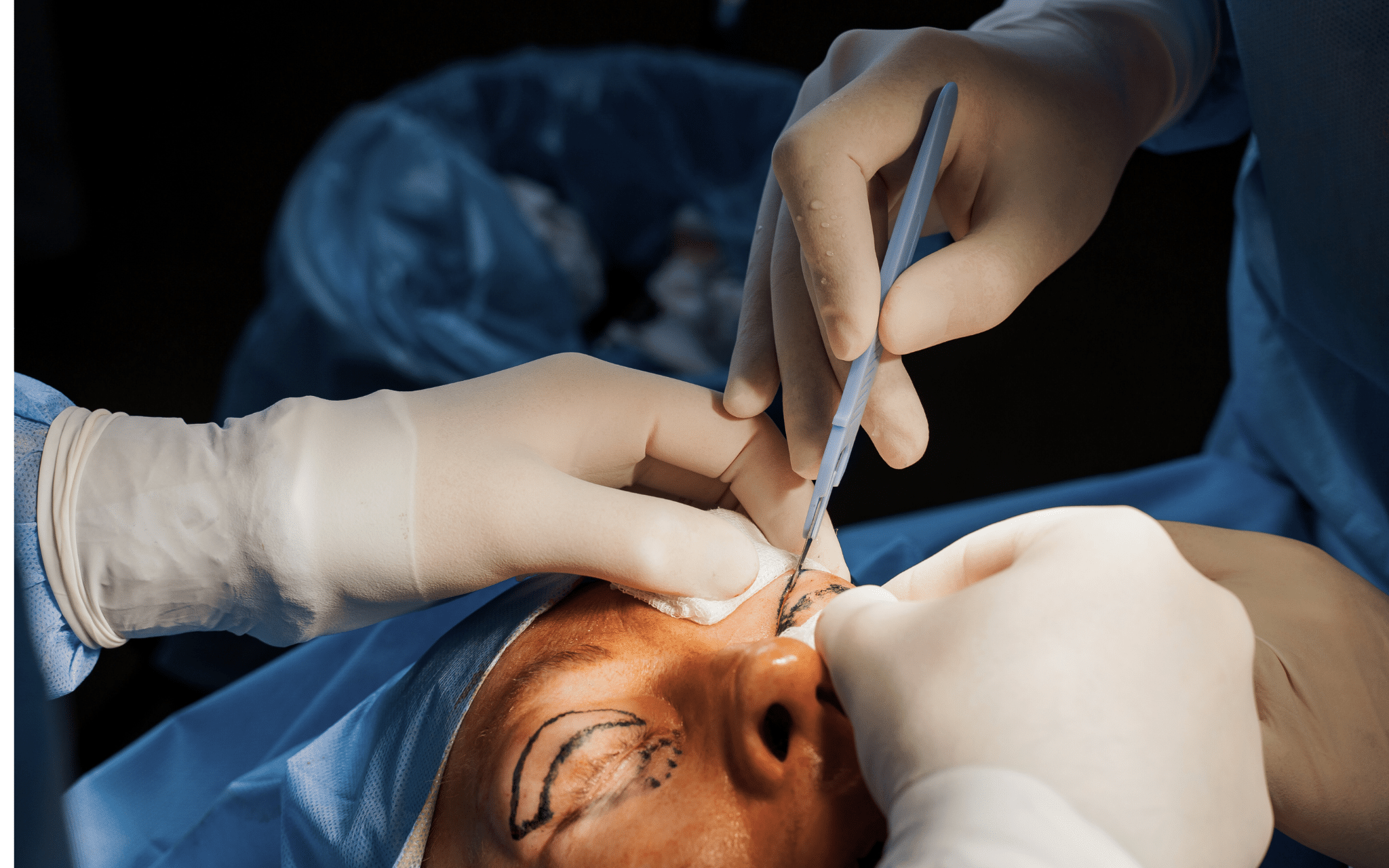 Блефаропластика нового поколения в клинике ADONIS Блефаропластика нового поколения в клинике ADONIS