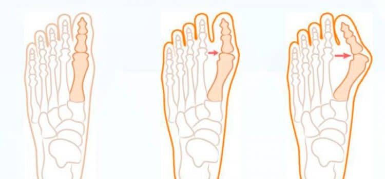 Операция на стопе и пальцах ног в Киеве Видалення кісточки на нозі (вальгусна деформація стопи)