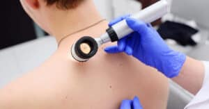 Лазерное удаление новообразований Лазерное удаление новообразований в ADONIS, Киев