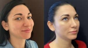 Ринопластика (пластика носа) в Киеве Ринопластика в Киеве