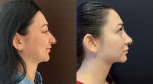 Ринопластика (пластика носа) в Киеве Пластика носа в ADONIS