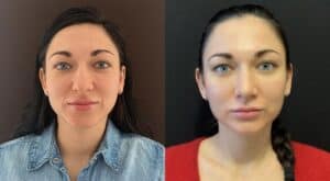 Ринопластика (пластика носа) в Киеве Пластика носа в Киеве