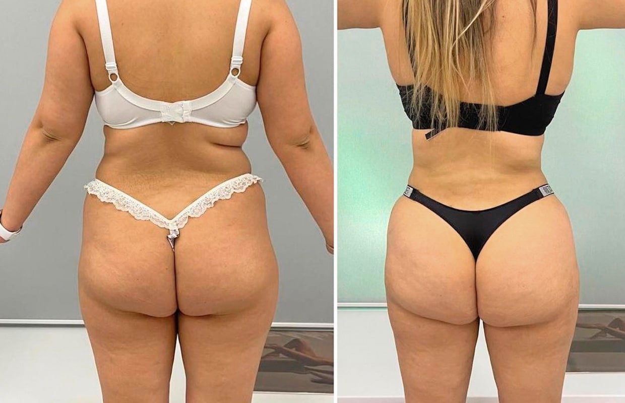 Липосакция Результати ліпосакції в ADONIS у Києві