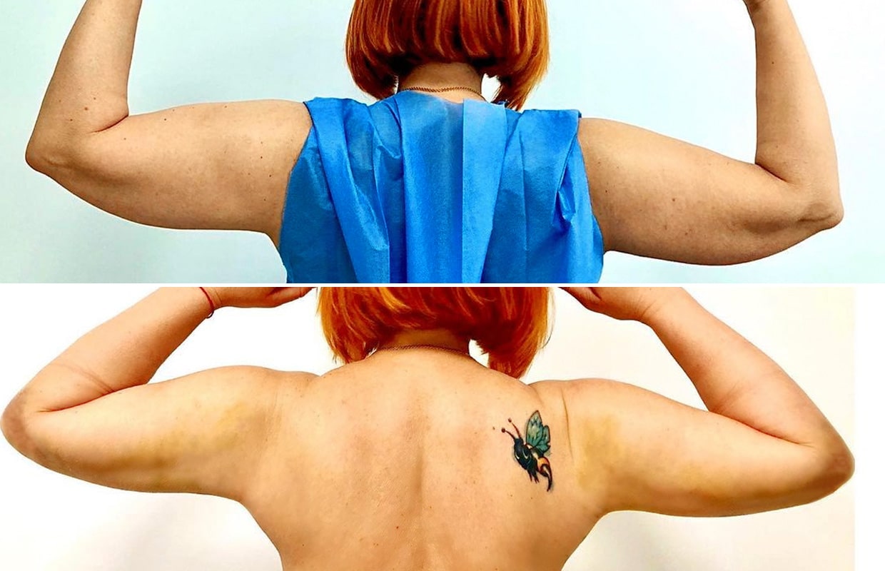 Липосакция Результати ліпосакції в ADONIS, Київ