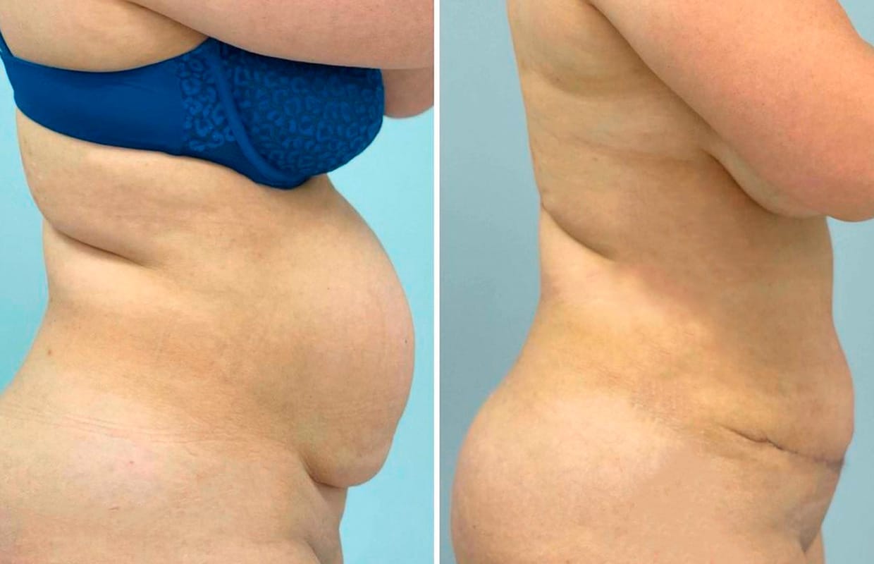 Липосакция Результати ліпосакції в ADONIS, Київ