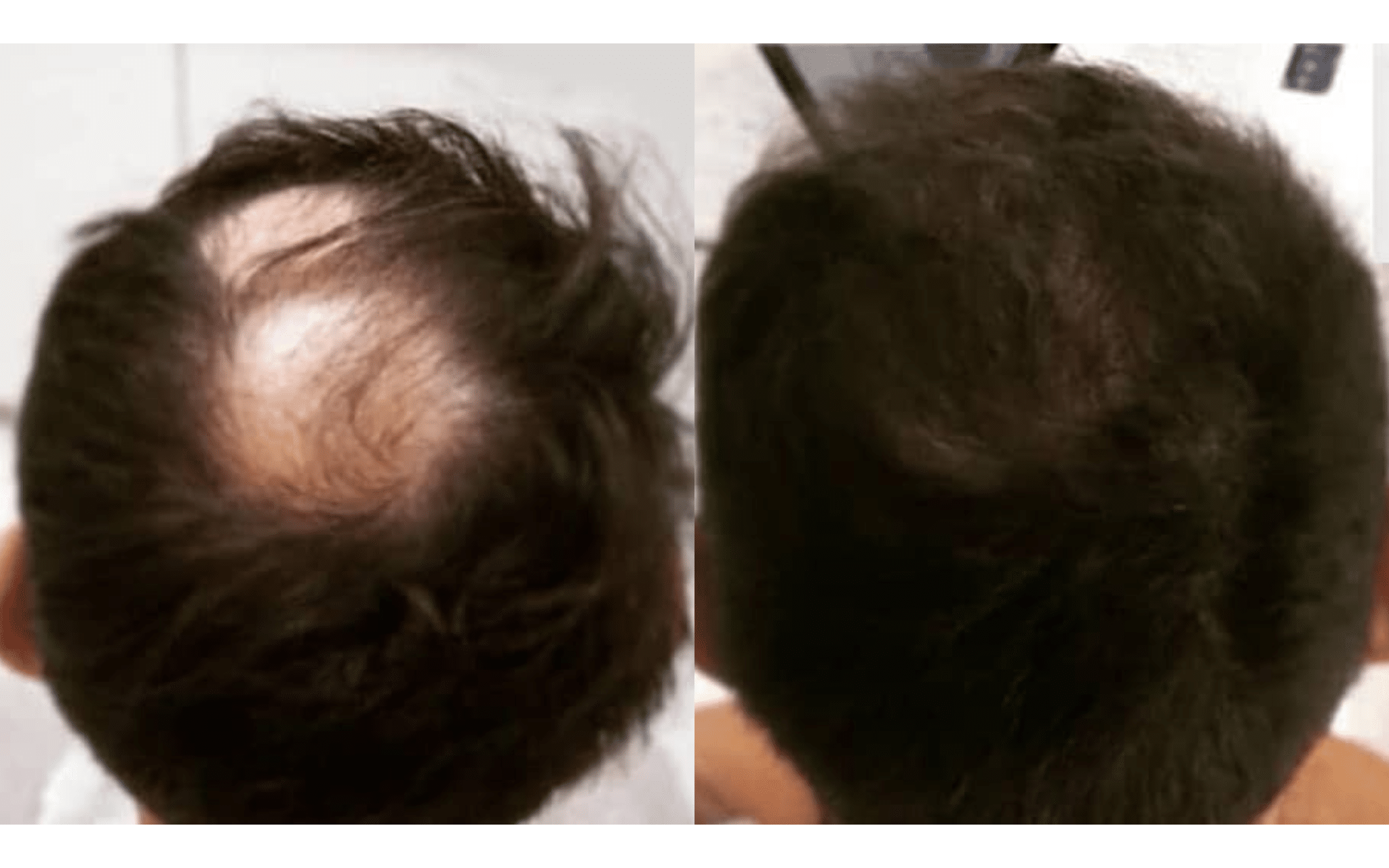 Пересадка волос в Киеве Результаты пересадки волос в ADONIS: До / После