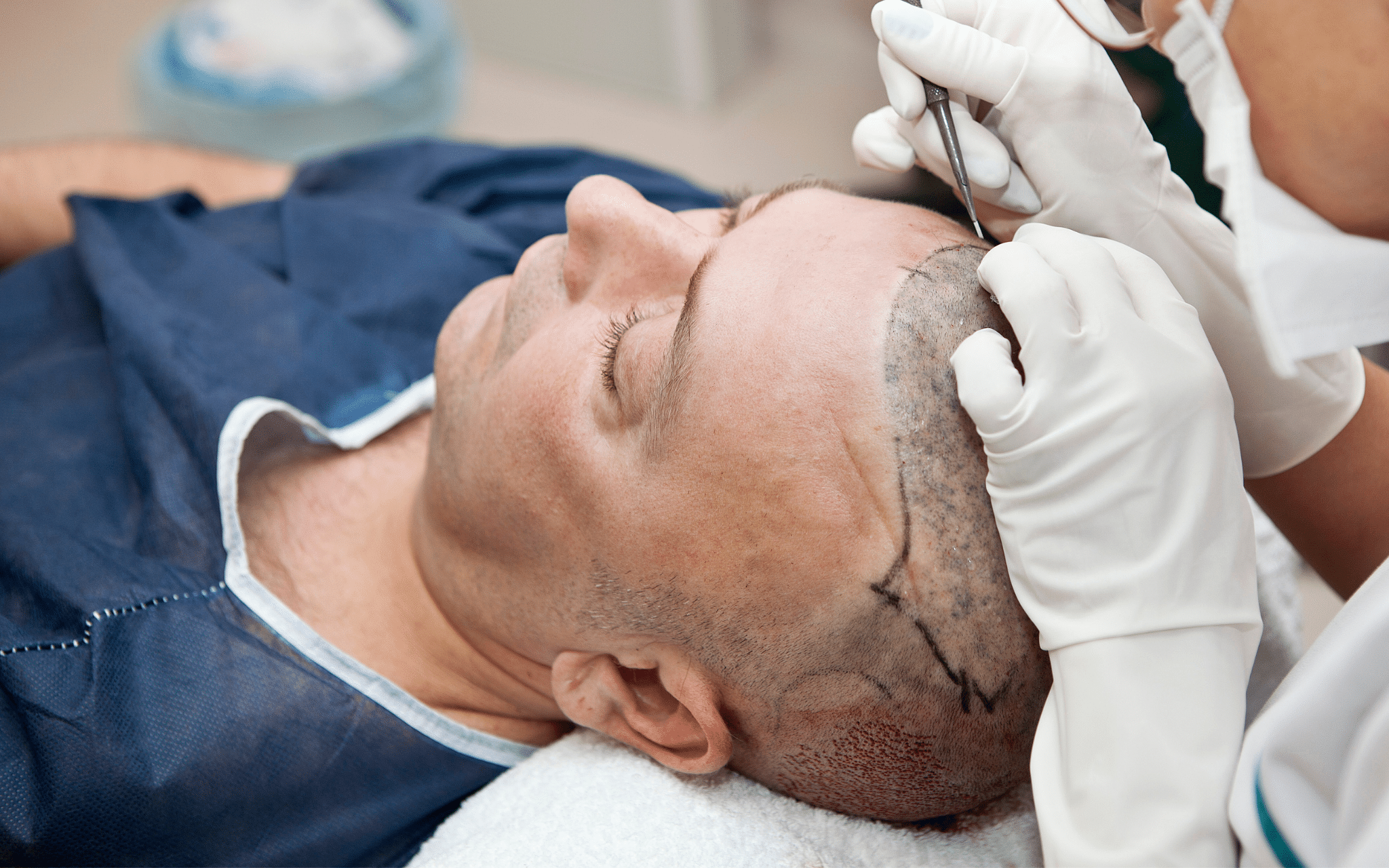 Пересадка волос в Киеве Пересадка волос в Киеве