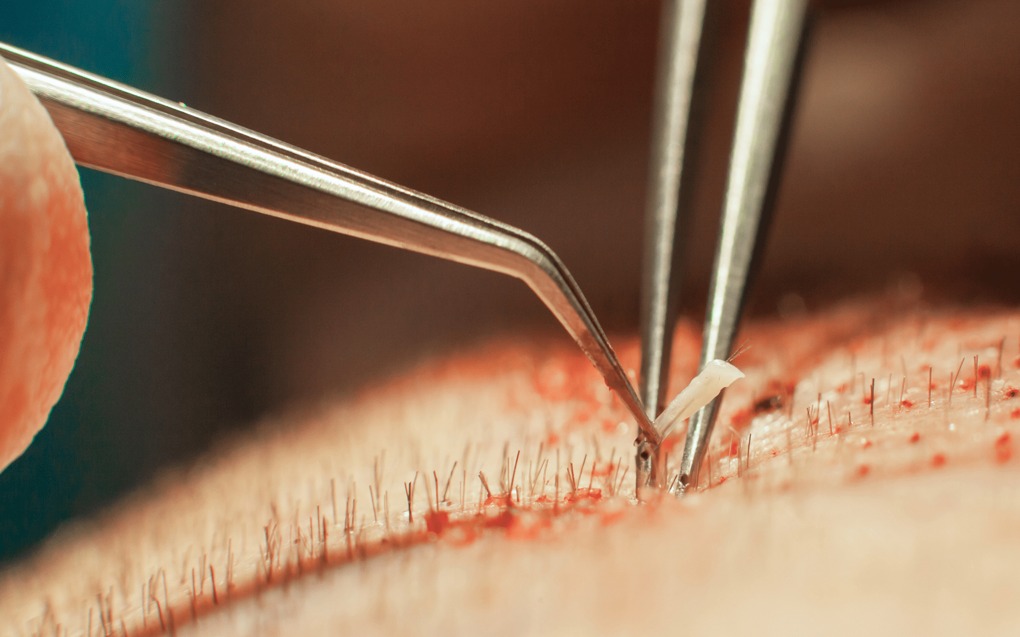 Пересадка волос в Киеве Пересадка волос в Киеве