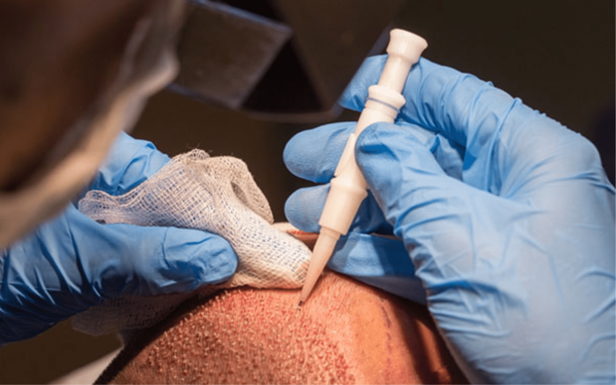 Пересадка волос в Киеве Пересадка волос в Киеве