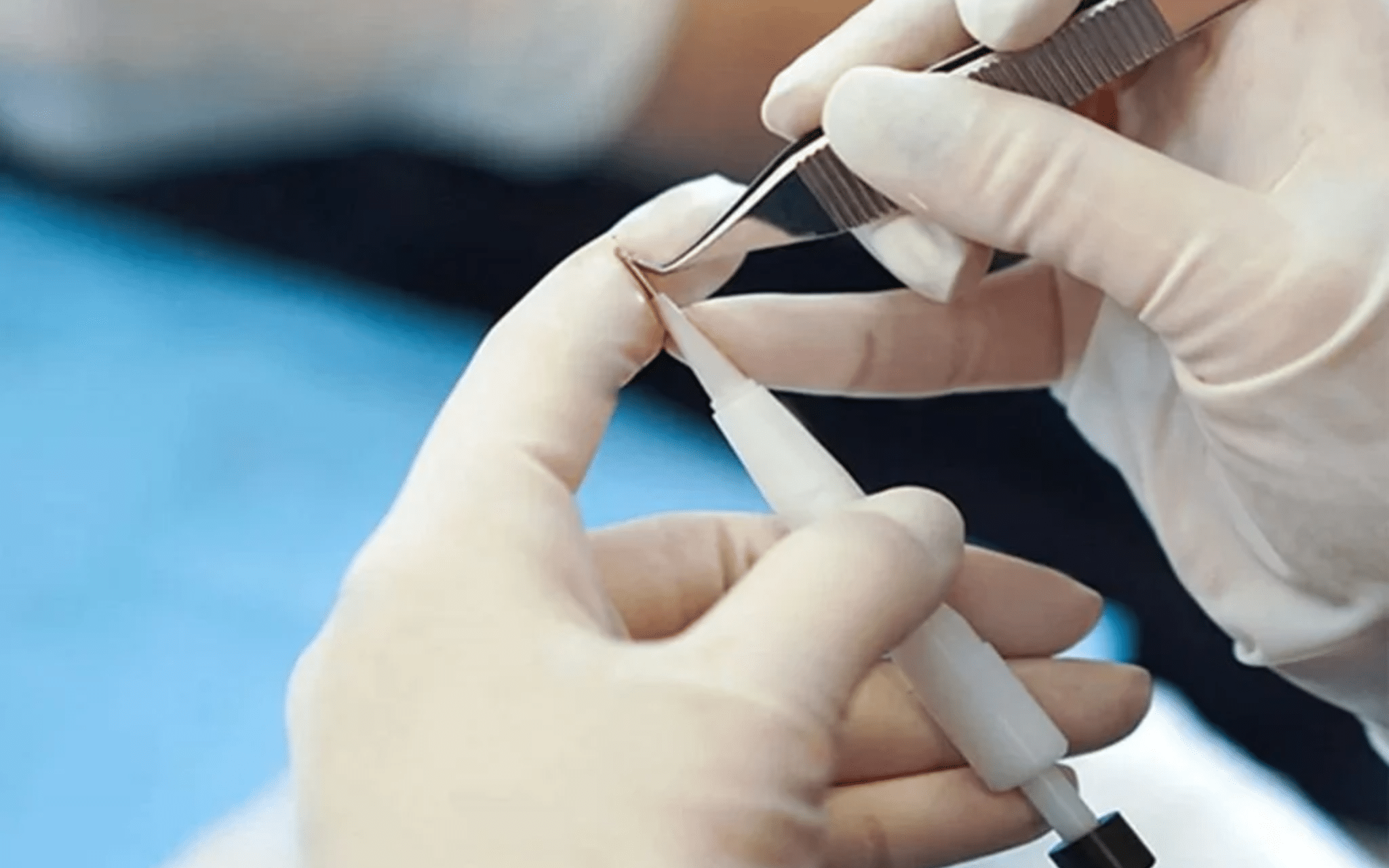 Пересадка волос в Киеве Пересадка волос в Киеве