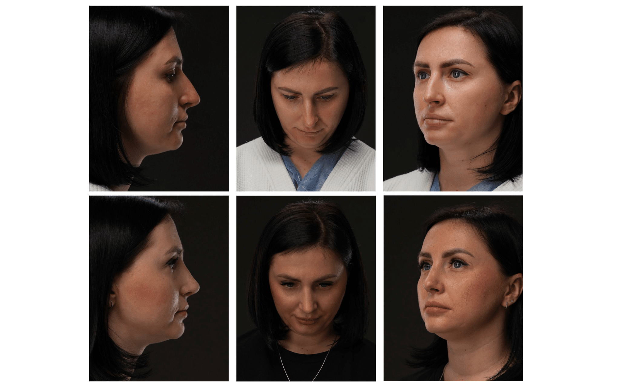 Септопластика носа в Киеве Септопластика носа в Киеве