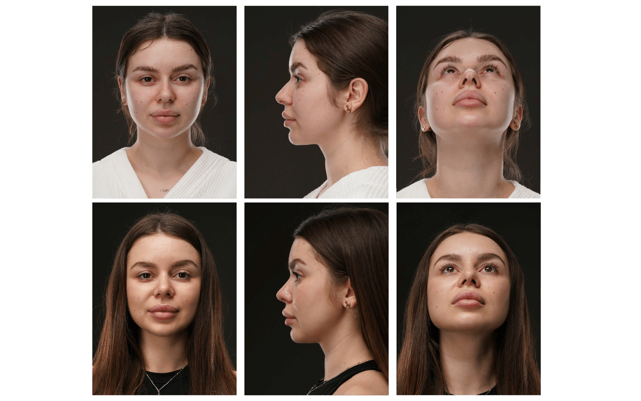 Септопластика носа в Киеве Септопластика носа в Киеве