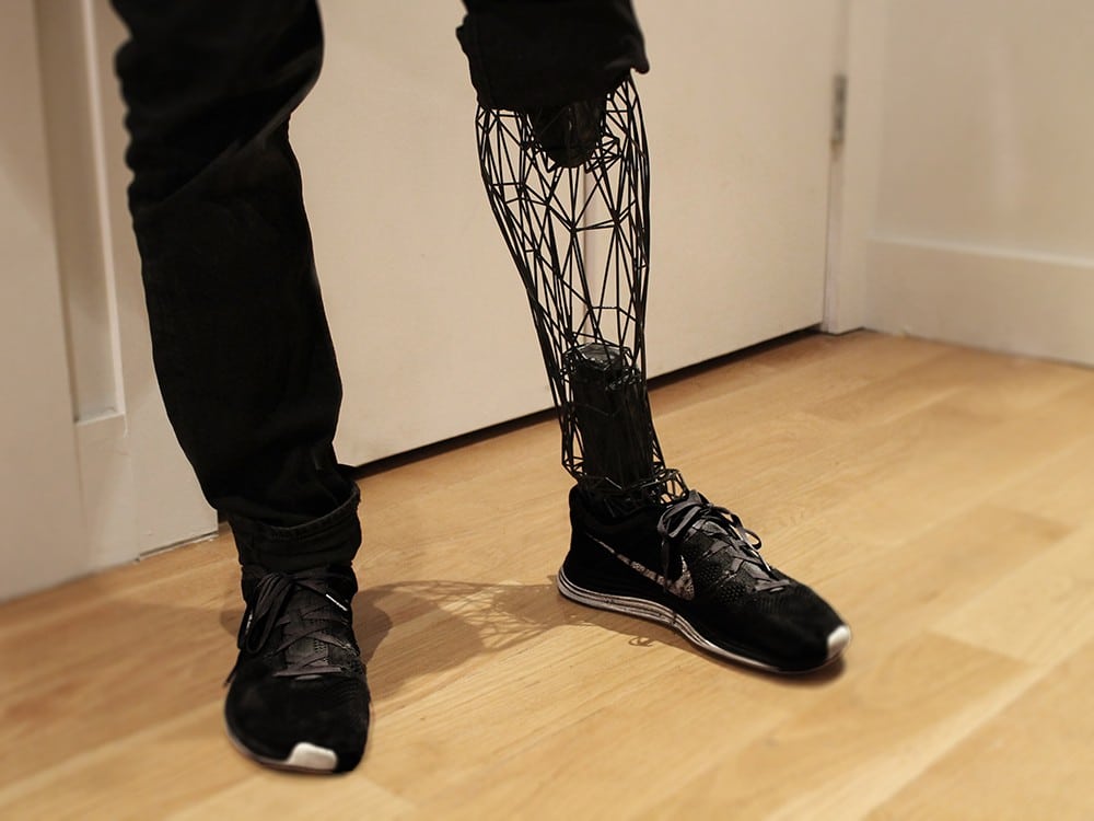 Реабилитационная программа пациентов при ампутациях нижних конечностей – ADONIS