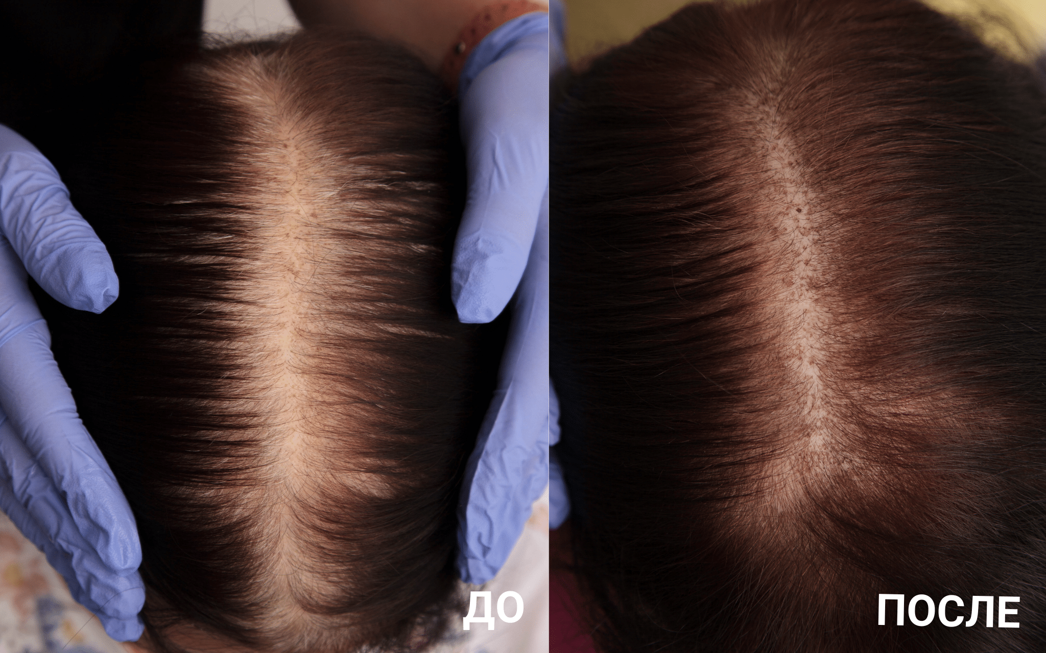 Экзосомы для волос Экзосомы для волос