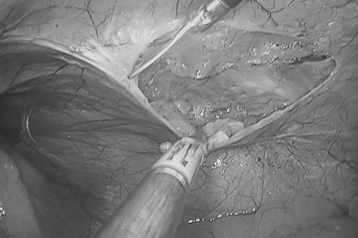 Удаление паховой грыжи "паховая грыжа операция"