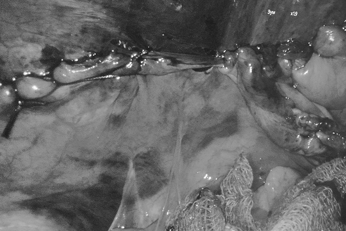 Удаление паховой грыжи "паховая грыжа операция"