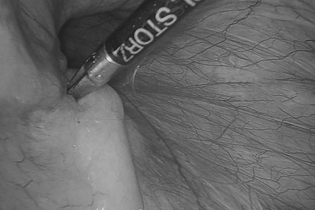 Удаление паховой грыжи "паховая грыжа операция"