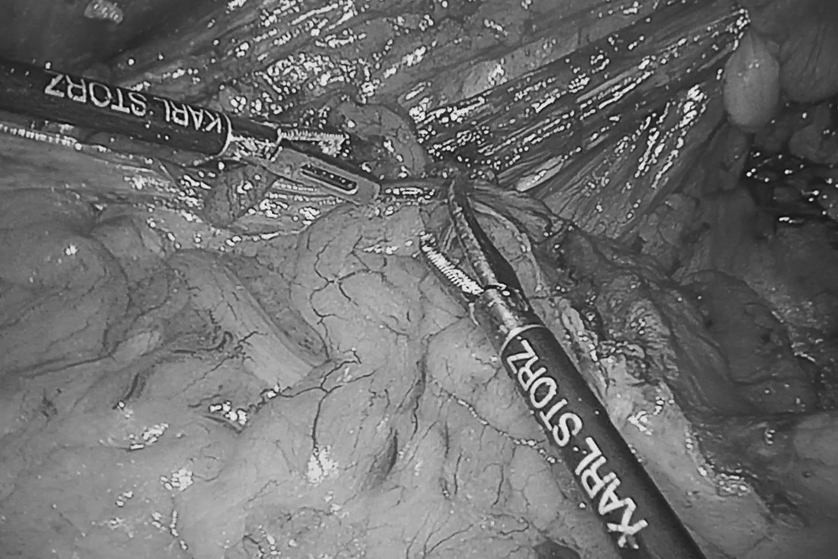 Удаление паховой грыжи "паховая грыжа операция"