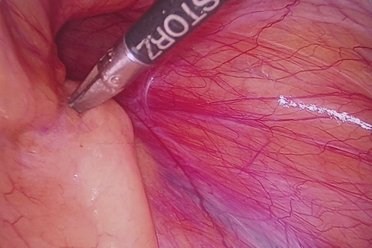 Удаление паховой грыжи "паховая грыжа операция"