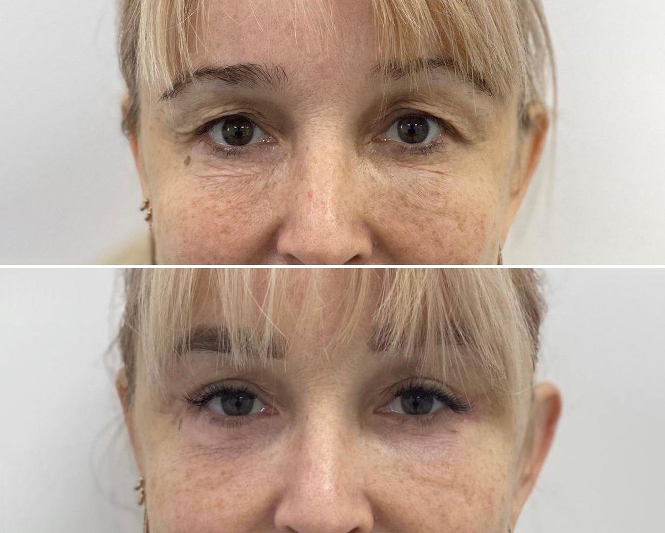 Пластическая хирургия в Киеве Блефаропластика в ADONIS