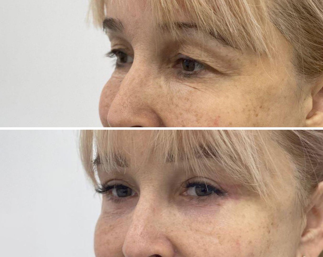 Пластическая хирургия в Киеве Виды блефаропластики в