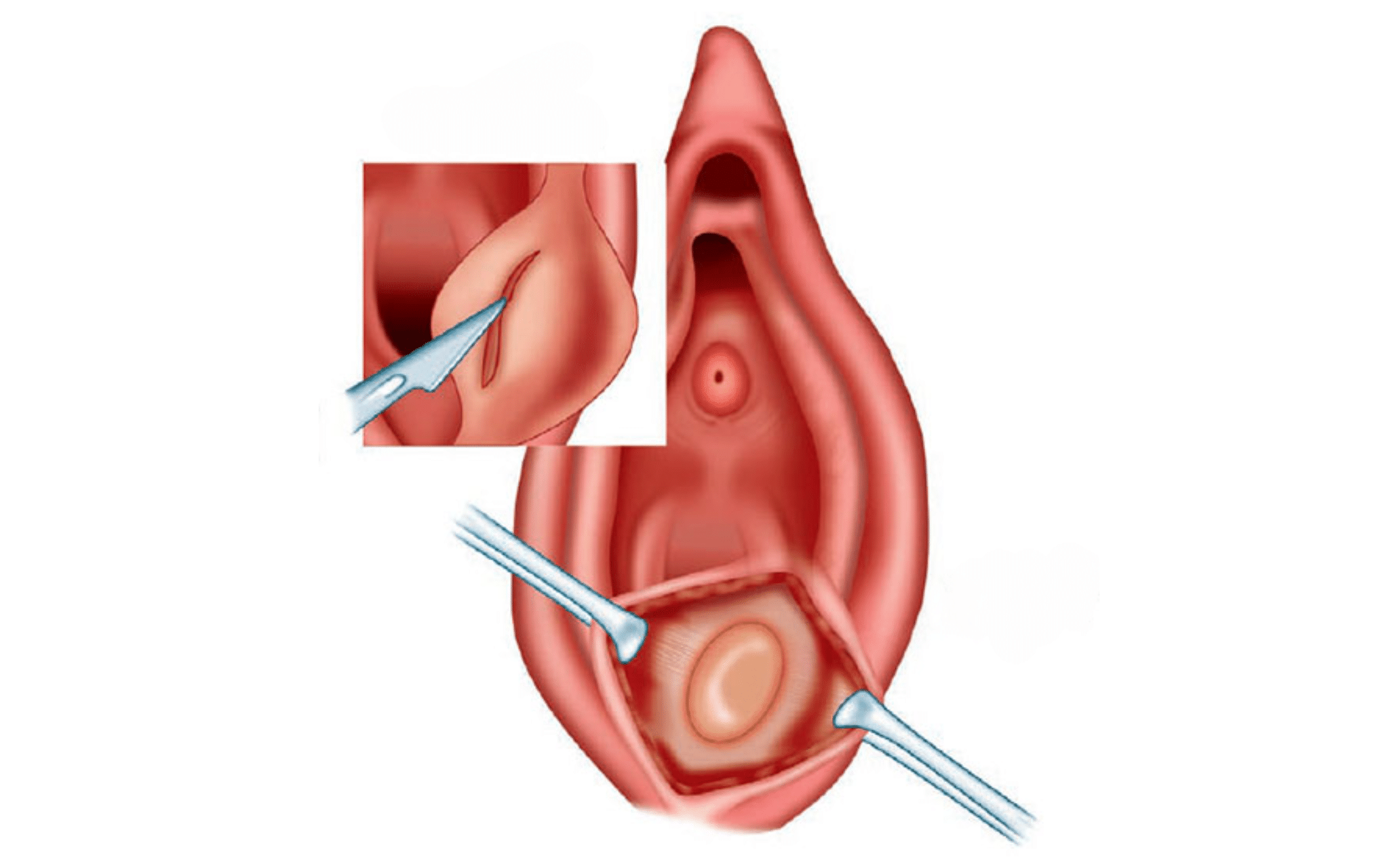 Удаление кисты бартолиновой железы в Киеве Удаление кисты бартолиновой железы в Киеве