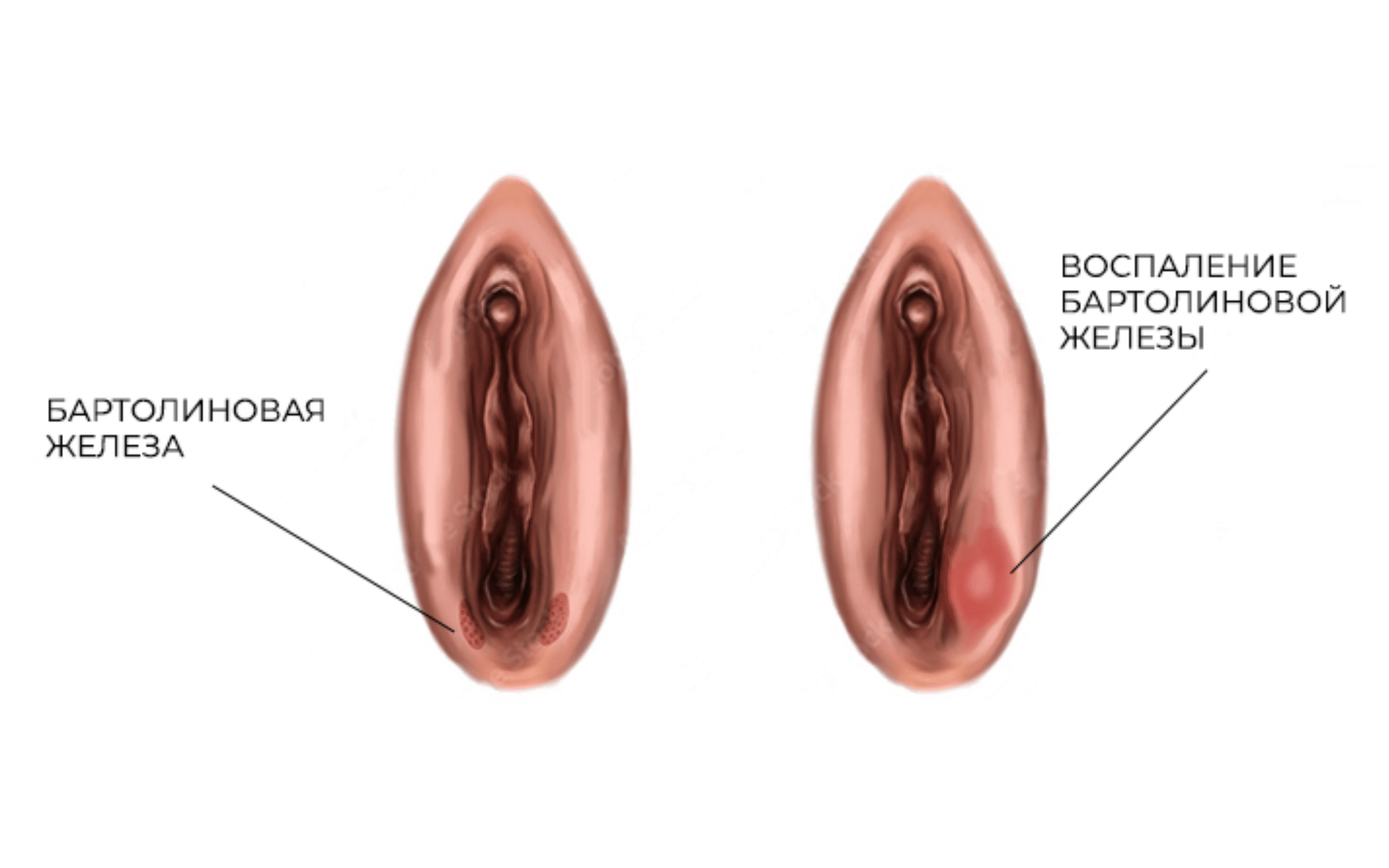 Удаление кисты бартолиновой железы в Киеве Удаление кисты бартолиновой железы в Киеве