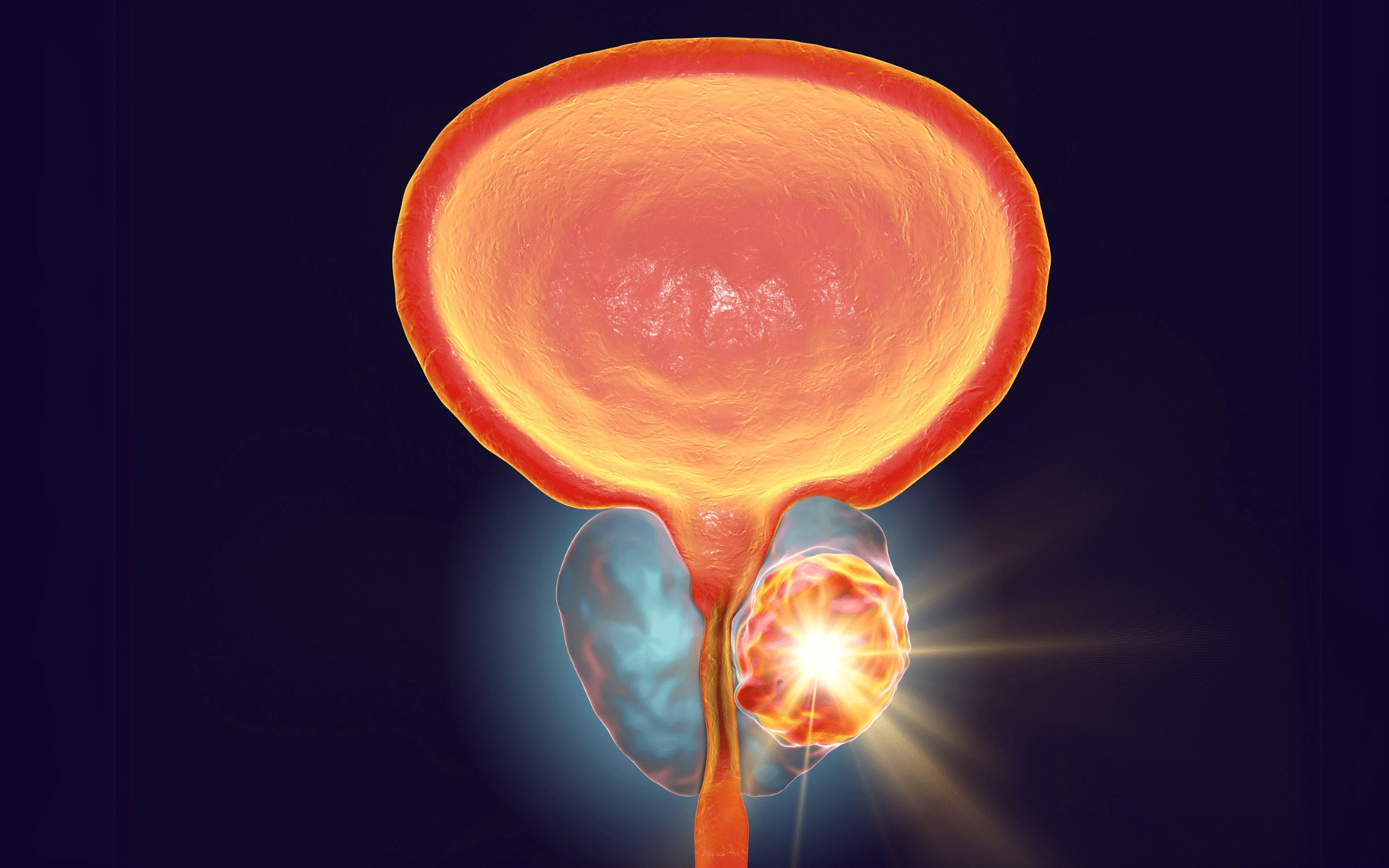Удаление простаты (Простатэктомия) в Киеве Удаление простаты (Простатэктомия) в Киеве