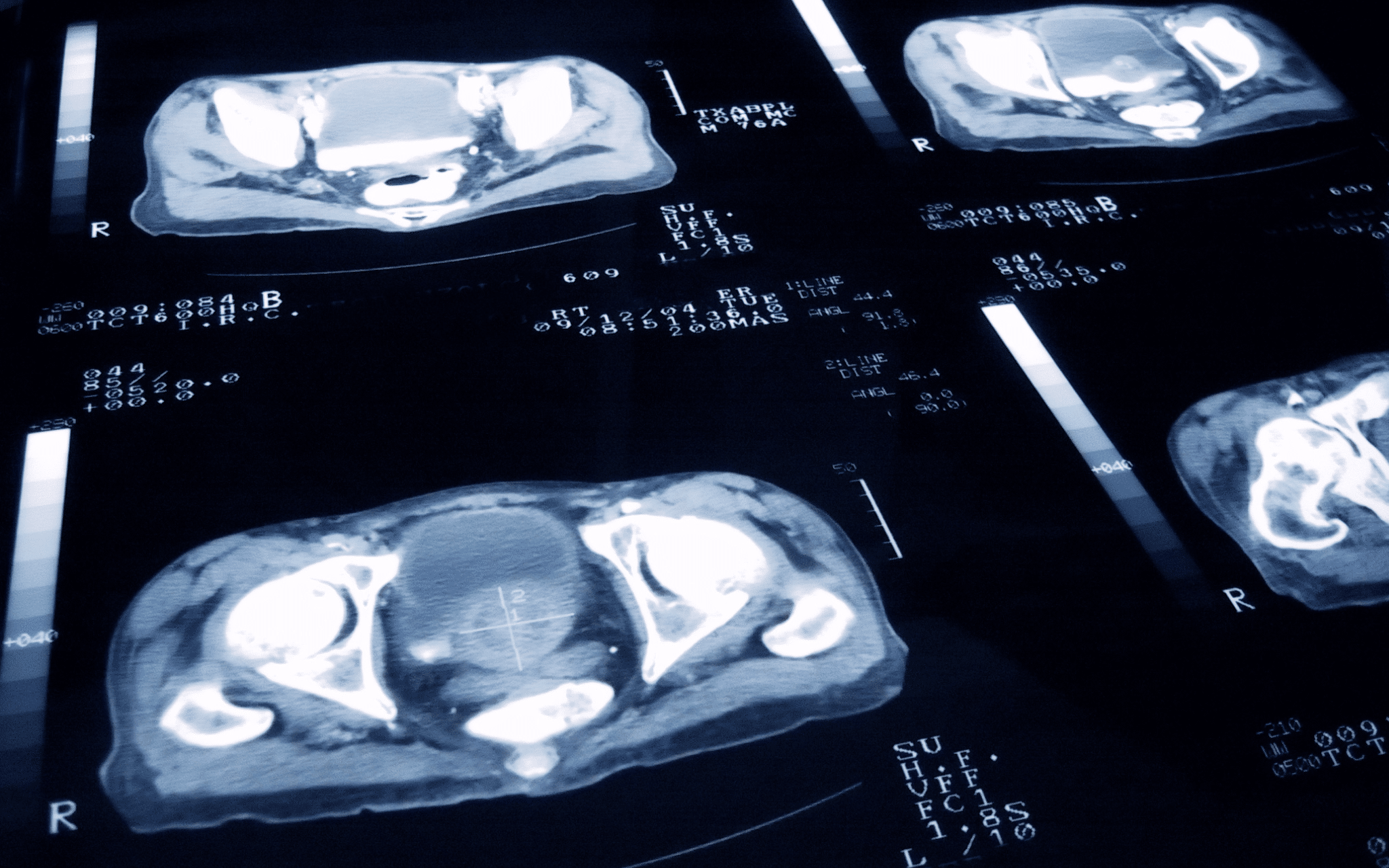 Удаление простаты (Простатэктомия) в Киеве Удаление простаты (Простатэктомия) в Киеве