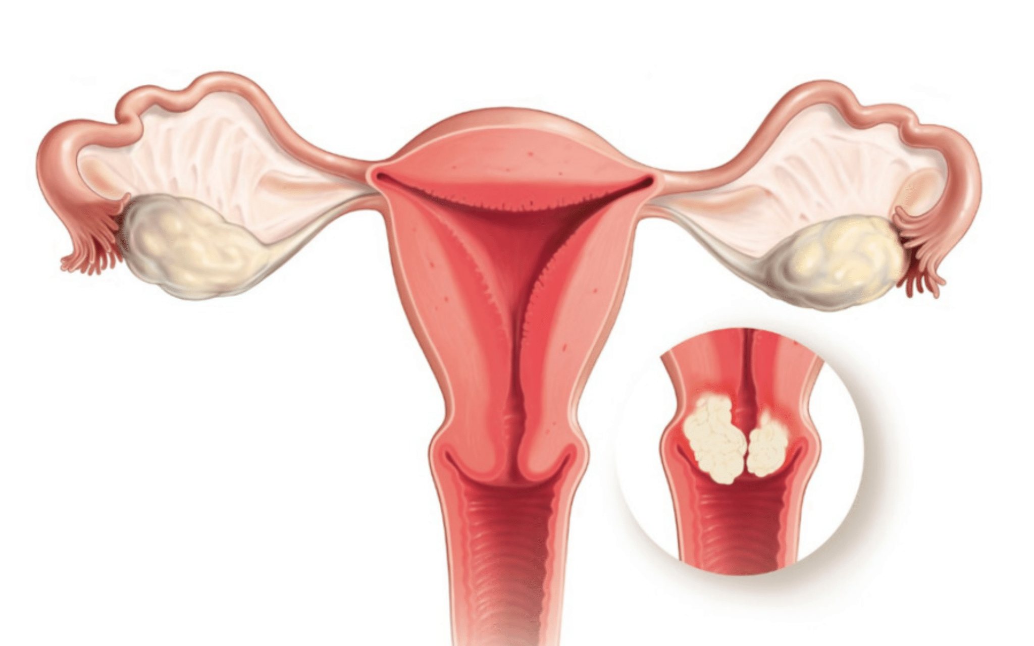 Рак шийки матки Рак шийки матки